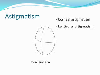 Astigmatism

- Corneal astigmatism
- Lenticular astigmatism

Toric surface

 