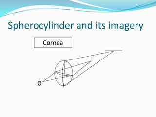 Spherocylinder and its imagery
Cornea

O

 