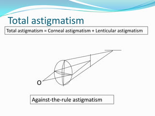 Total astigmatism
Total astigmatism = Corneal astigmatism + Lenticular astigmatism

O
Against-the-rule astigmatism

 