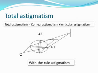 Total astigmatism
Total astigmatism = Corneal astigmatism +lenticular astigmatism

42

40

O
With-the-rule astigmatism

 