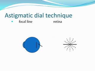 Astigmatic dial technique


focal line

retina

 
