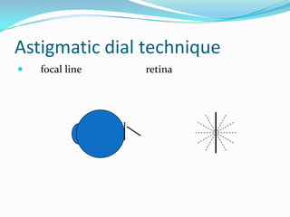 Astigmatic dial technique


focal line

retina

 