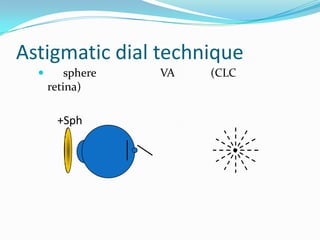Astigmatic dial technique


sphere
retina)

+Sph

VA

(CLC

 