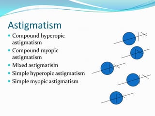 Astigmatism
 Compound hyperopic

astigmatism
 Compound myopic
astigmatism
 Mixed astigmatism
 Simple hyperopic astigmatism
 Simple myopic astigmatism

 