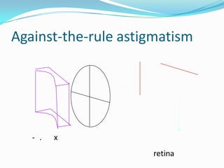 Against-the-rule astigmatism

- .

x
retina

 