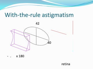 With-the-rule astigmatism
42

40

- .

x 180
retina

 