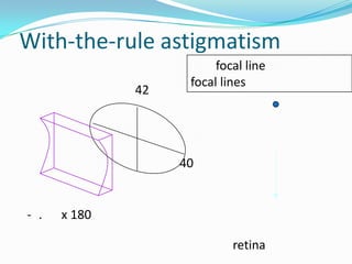 With-the-rule astigmatism
42

focal line
focal lines

40

- .

x 180
retina

 