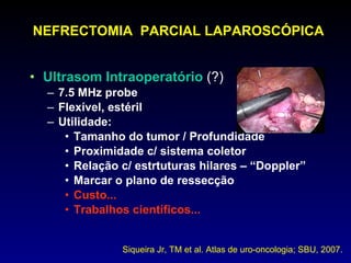 NEFRECTOMIA  PARCIAL LAPAROSCÓPICA Ultrasom Intraoperatório  (?) 7.5 MHz probe Flexível, estéril Utilidade: Tamanho do tumor / Profundidade Proximidade c/ sistema coletor Relação c/ estrtuturas hilares – “Doppler” Marcar o plano de ressecção Custo... Trabalhos científicos...  Siqueira Jr, TM et al. Atlas de uro-oncologia; SBU, 2007. 
