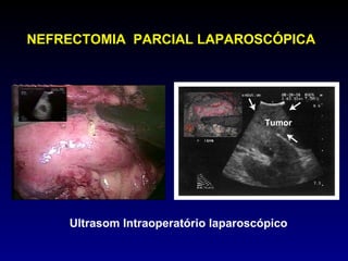 NEFRECTOMIA  PARCIAL LAPAROSCÓPICA Ultrasom Intraoperatório laparoscópico Tumor 