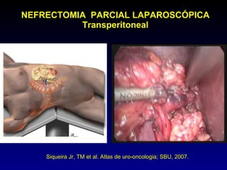NEFRECTOMIA  PARCIAL LAPAROSCÓPICA Transperitoneal Siqueira Jr, TM et al. Atlas de uro-oncologia; SBU, 2007.  