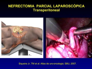 NEFRECTOMIA  PARCIAL LAPAROSCÓPICA Transperitoneal Siqueira Jr, TM et al. Atlas de uro-oncologia; SBU, 2007.  
