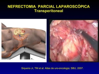 NEFRECTOMIA  PARCIAL LAPAROSCÓPICA Transperitoneal Siqueira Jr, TM et al. Atlas de uro-oncologia; SBU, 2007. 