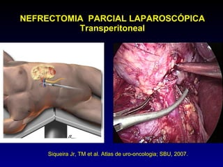 NEFRECTOMIA  PARCIAL LAPAROSCÓPICA Transperitoneal Siqueira Jr, TM et al. Atlas de uro-oncologia; SBU, 2007. 