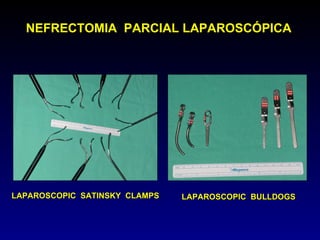 NEFRECTOMIA  PARCIAL LAPAROSCÓPICA LAPAROSCOPIC  BULLDOGS LAPAROSCOPIC  SATINSKY  CLAMPS 