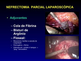 NEFRECTOMIA  PARCIAL LAPAROSCÓPICA Adjuvantes  Cola de Fibrina Bisturí de Argônio Floseal: Mecanismo: facilitar a cascata de coagulação Fibrinogênio   fibrina Grânulos em  contato c/ sangue     “plug “ hemostático 