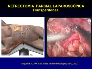 NEFRECTOMIA  PARCIAL LAPAROSCÓPICA Transperitoneal Siqueira Jr, TM et al. Atlas de uro-oncologia; SBU, 2007. 