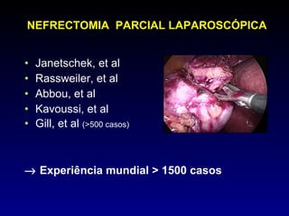 NEFRECTOMIA  PARCIAL LAPAROSCÓPICA Janetschek, et al Rassweiler, et al Abbou, et al Kavoussi, et al Gill, et al  (>500 casos)    Experiência mundial > 1500 casos 