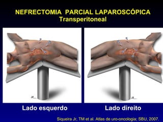 NEFRECTOMIA  PARCIAL LAPAROSCÓPICA Transperitoneal Lado esquerdo Lado direito Siqueira Jr, TM et al. Atlas de uro-oncologia; SBU, 2007. 