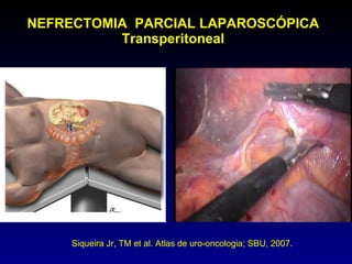 NEFRECTOMIA  PARCIAL LAPAROSCÓPICA Transperitoneal Siqueira Jr, TM et al. Atlas de uro-oncologia; SBU, 2007.  