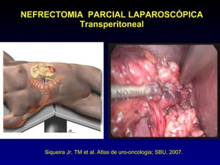 Nefrectomia parcial laparoscópica 