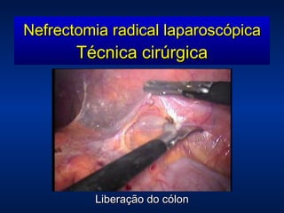 Nefrectomia radical laparoscópica Técnica cirúrgica Liberação do cólon 