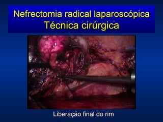 Liberação final do rim Nefrectomia radical laparoscópica Técnica cirúrgica 