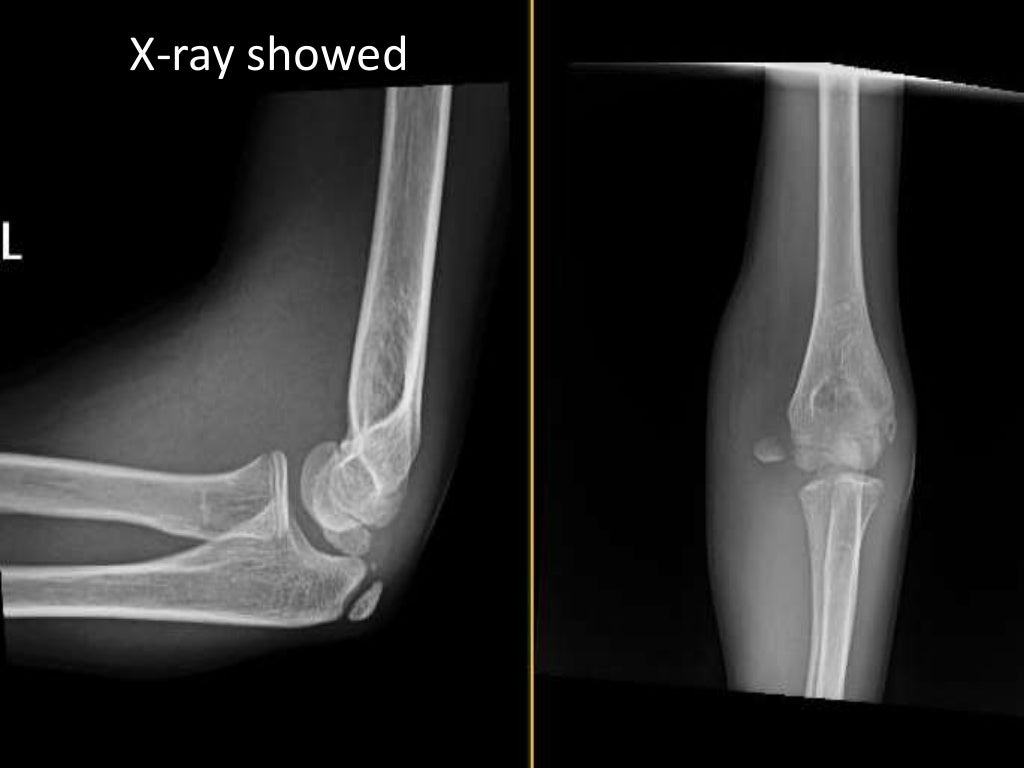 Medial epicondyle fracturepediatric.ppt