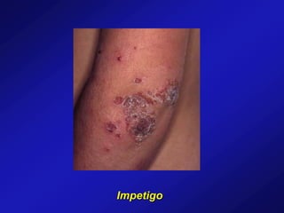 Impetigo
 