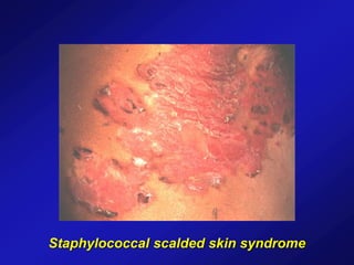 Staphylococcal scalded skin syndrome
 