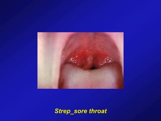 Strep_sore throat
 