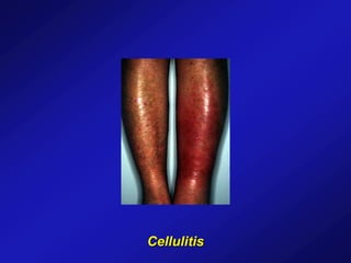 Cellulitis
 