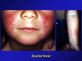 Scarlet fever
 