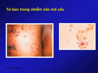 Cơ chế gây bệnh
Tử ban trong nhiễm não mô cầu
 