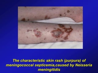 The characteristic skin rash (purpura) of
meningococcal septicemia,caused by Neisseria
meningitidis
 