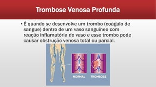 Trombose Venosa Profunda
▪ É quando se desenvolve um trombo (coágulo de
sangue) dentro de um vaso sanguíneo com
reação inflamatória do vaso e esse trombo pode
causar obstrução venosa total ou parcial.
 
