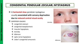  A horizontal slow pendular nystagmus
usually associated with sensory deprivation
due to reduced central visual acuity
 common causes:
 congenital cataract
 congenital toxoplasmosis
 macular hypoplasia
 Aniridia
 Albinism
 optic nerve hypoplasia
 Leber’s congenital amaurosis
CONGENITAL PENDULAR (OCULAR) NYSTAGMUS
SENSORYDEPRIVATION(OCULAR)NYSTAGMUS
Aniridia
Albinism
 