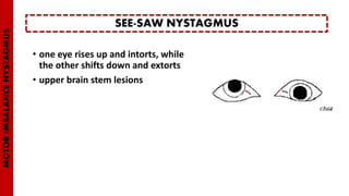 • one eye rises up and intorts, while
the other shifts down and extorts
• upper brain stem lesions
SEE-SAW NYSTAGMUS
MOTORIMBALANCENYSTAGMUS
 