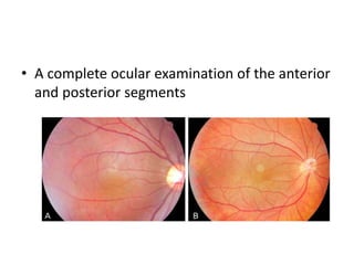 • A complete ocular examination of the anterior
and posterior segments
 