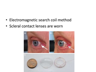 • Electromagnetic search coil method
• Scleral contact lenses are worn
 
