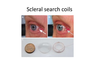 Scleral search coils
 
