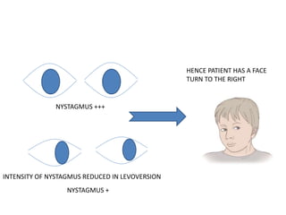 NYSTAGMUS +++
INTENSITY OF NYSTAGMUS REDUCED IN LEVOVERSION
NYSTAGMUS +
HENCE PATIENT HAS A FACE
TURN TO THE RIGHT
 