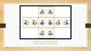 Nystagmus is uniplanner , pendular,
equal amplitude in all directions.
 