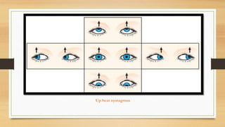 Up beat nystagmus
 