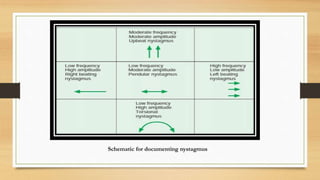 Schematic for documenting nystagmus
 