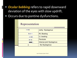  Ocular bobbing refers to rapid downward
deviation of the eyes with slow updrift.
 Occurs due to pontine dysfunctions.
 