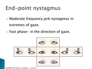  Moderate frequency jerk nystagmus in
extremes of gaze.
 Fast phase- in the direction of gaze.
 