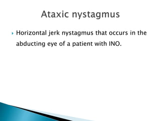  Horizontal jerk nystagmus that occurs in the
abducting eye of a patient with INO.
 