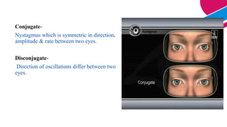 Conjugate-
Nystagmus which is symmetric in direction,
amplitude & rate between two eyes.
Disconjugate-
Direction of oscillations differ between two
eyes.
 