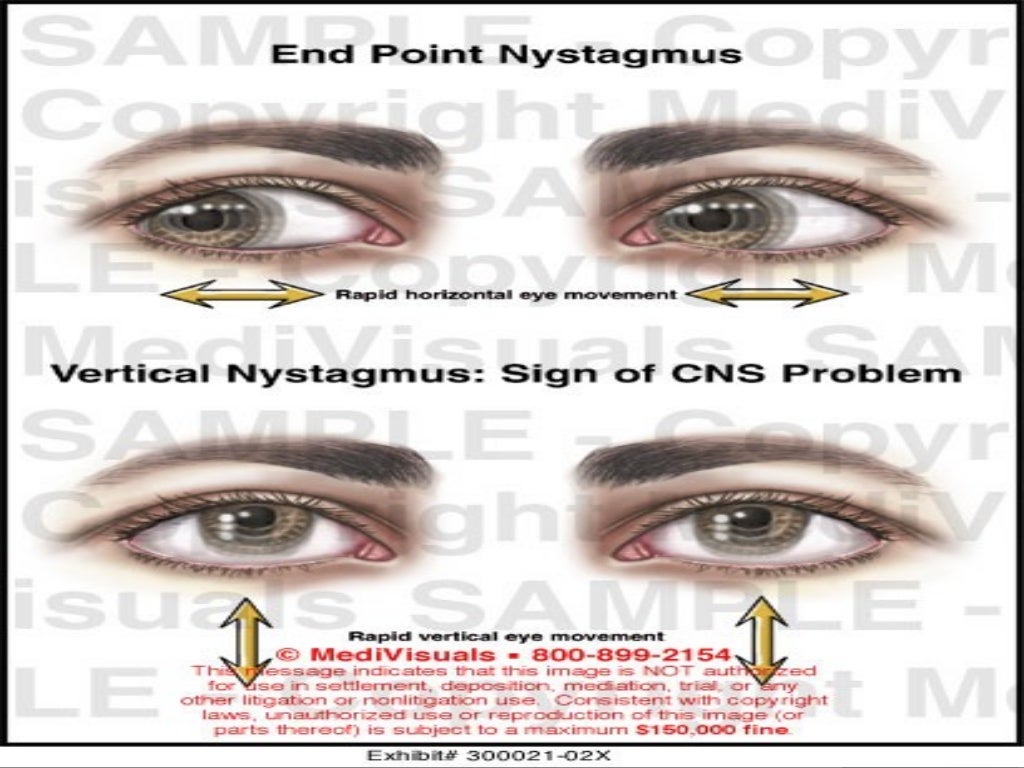 Nystagmus by yehia matter