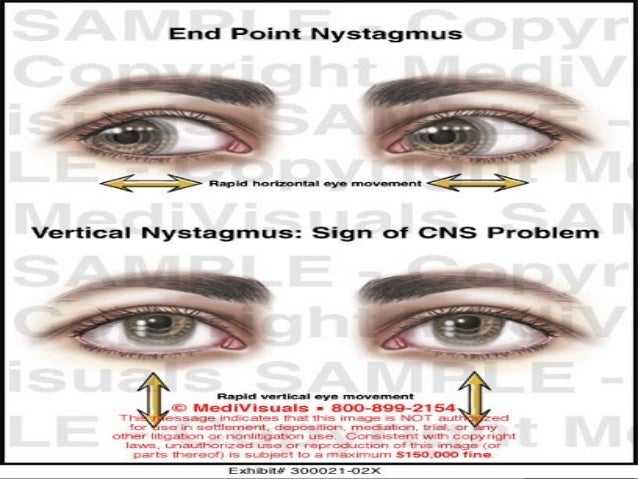 nystagmus by yehia matter nystagmus by yehia matter, Skeleton